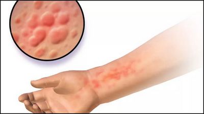 Cures For Aquagenic Urticaria and minerals which can improve