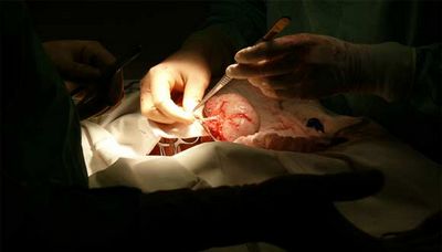 Cyst Removal Surgery - What You Need to Know About it This can cause further complications