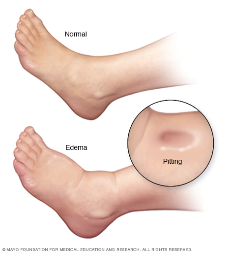 EDema - What is it? pool can also develop