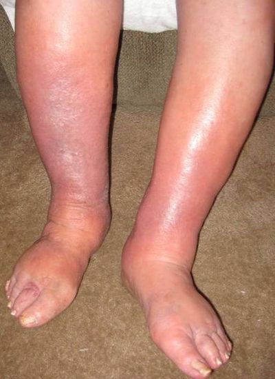 EDema - What is it? Another option to relieve the