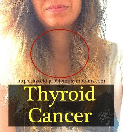 Thyroid Cancer own hormones