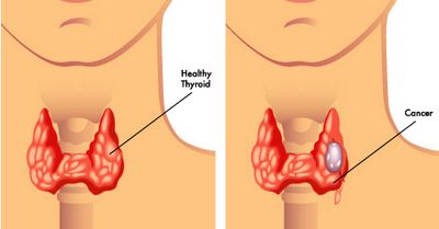 Thyroid Cancer Thyroid cancer