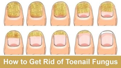 Treatment For Toenail Fungus - How to Get Rid of Toenail Fungus One type of