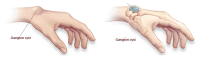 Treatment of a Ganglion Cyst - How to Treat a Ganglion Cyst safest way to