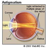 What Is Astigmatism? your life as normal