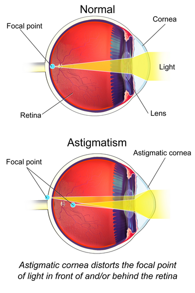 What Is Astigmatism? of the most
